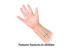 Forearm Fractures in Children